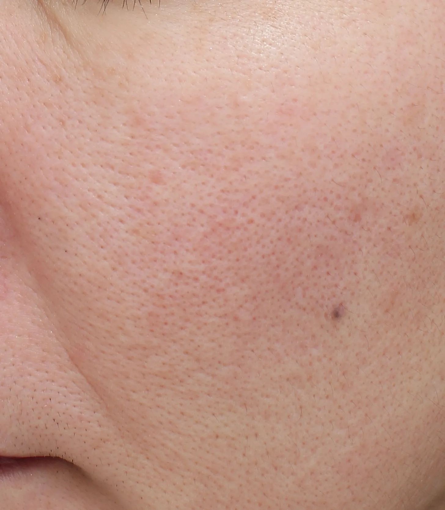 Naris Natural Skincare Before